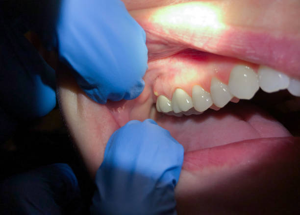 Best Emergency Dental Filling Replacement  in Chelsea, OK
